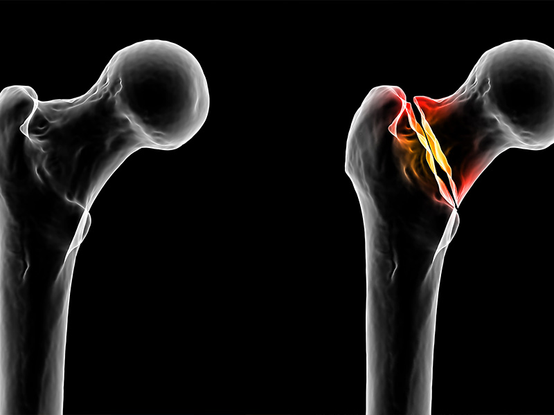 What Treatments Are Available for Bone and Joint Injuries? - Türkiye ...